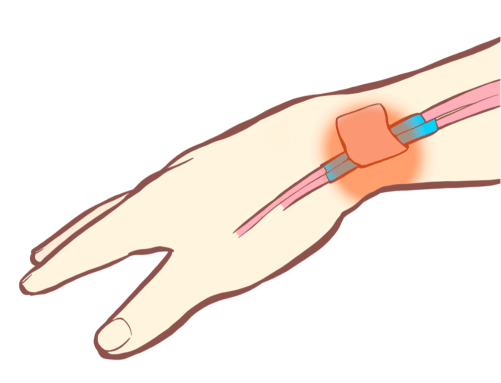 腱鞘炎,筋膜リリース