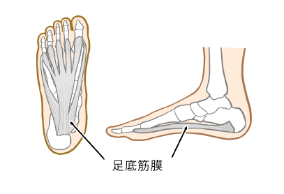 足底筋膜炎